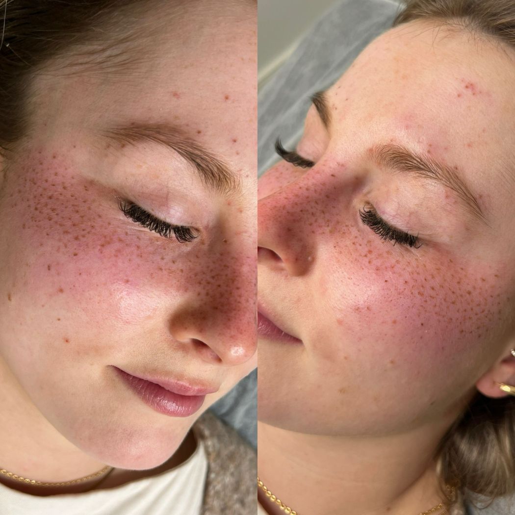 Sommersprossen Permanent Make-Up bei Aesthetik by Ina Zierhut