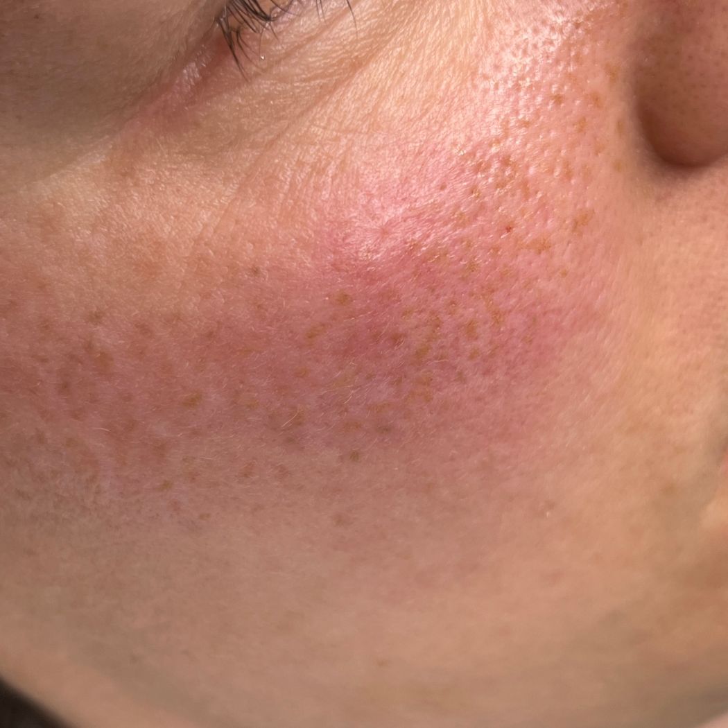Sommersprossen Permanent Make-Up bei Aesthetik by Ina Zierhut